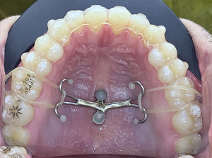 Coluna Ortodontia e Ideias – Tratamento objetivo de mordida aberta anterior utilizando Invisalign® e ancoragem esquelética – relato de caso