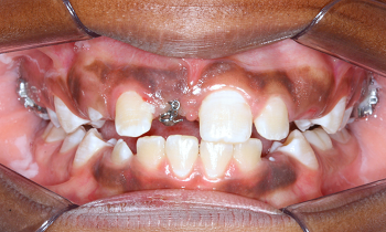 Tracionamento ortodôntico de incisivo central superior impactado associado a odontoma – relato de caso