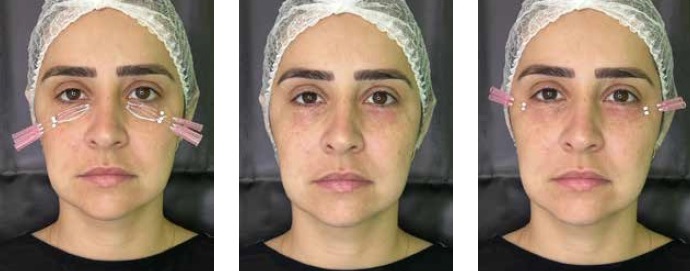 Treatment of flacidity in eye-dark circles with PDO and hyperdiluted calcium hydroxyapathite