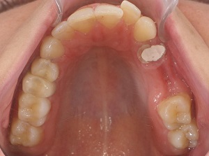 Orthodontic approach to malocclusion originating from a self-intervention – case report