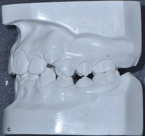 Corrective treatment of maxillary atresia associated with deep overbite in angle Class II patient – case report