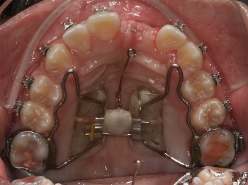 Is it possible to perform surgical orthodontic traction on incisor with root dilaceration?