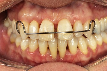 Minimally invasive orthodontics can help aesthetic rehabilitation of the upper anterior teeth – a case report