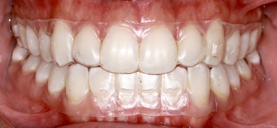 A simple and efficient alternative for the correction of relapses after 15 years of orthodontic treatment – case report