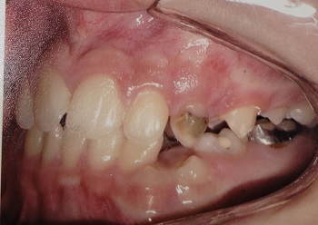Orthodontic treatment of a patient with Treacher Collins syndrome – case report