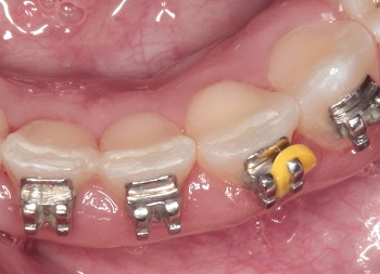 The versatility of elastomeric ligatures in the correction of single tooth rotations