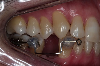 Alinhadores x ortodontia fixa – relato de caso