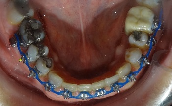 A utilização de torques resistentes ao movimento compensatório dos dentes anteriores no tratamento da Classe III no paciente adulto